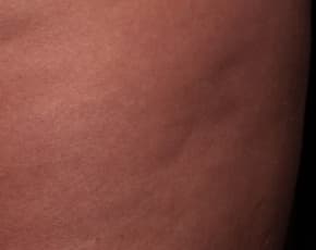 Cellfina Before & After Patient #2215