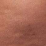 Cellfina Before & After Patient #2214