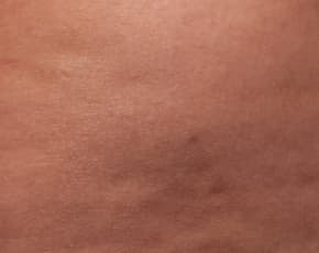 Cellfina Before & After Patient #2214