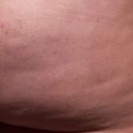 Cellfina Before & After Patient #2213