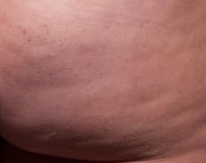 Cellfina Before & After Patient #2213