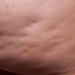 Cellfina Before & After Patient #2213