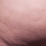Cellfina Before & After Patient #2212