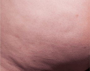Cellfina Before & After Patient #2212