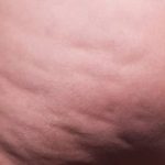 Cellfina Before & After Patient #2212