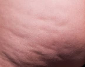 Cellfina Before & After Patient #2212