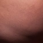 Cellfina Before & After Patient #2211