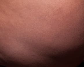 Cellfina Before & After Patient #2211
