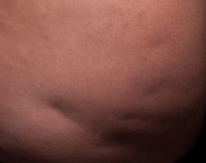 Cellfina Before & After Patient #2211