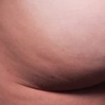 Cellfina Before & After Patient #2210