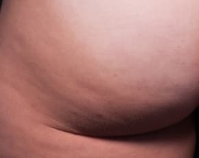 Cellfina Before & After Patient #2210