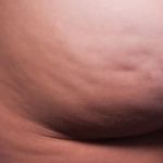 Cellfina Before & After Patient #2210