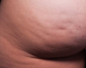 Cellfina Before & After Patient #2210