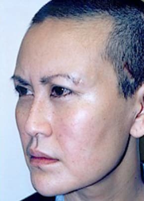 Cheeklift Threadlift Before & After Patient #1923