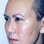 Cheeklift Threadlift Before & After Patient #2284