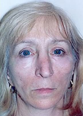 Cheeklift Threadlift Before & After Patient #1922