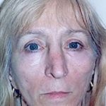 Cheeklift Threadlift Before & After Patient #2283