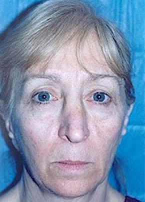 Cheeklift Threadlift Before & After Patient #1922