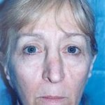Cheeklift Threadlift Before & After Patient #2283