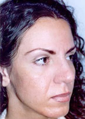 Cheeklift Threadlift Before & After Patient #1921