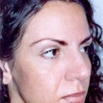 Cheeklift Threadlift Before & After Patient #2282