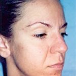 Cheeklift Threadlift Before & After Patient #1921