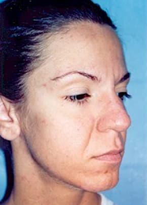 Cheeklift Threadlift Before & After Patient #1921
