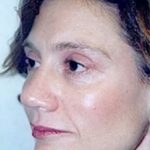 Cheeklift Threadlift Before & After Patient #2281