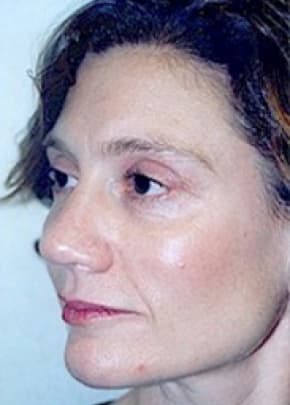 Cheeklift Threadlift Before & After Patient #2281