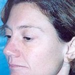 Cheeklift Threadlift Before & After Patient #2281