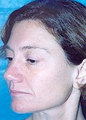 Cheeklift Threadlift Before & After Patient #2281