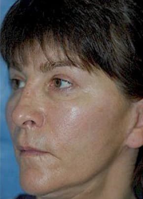 Cheeklift Threadlift Before & After Patient #2280