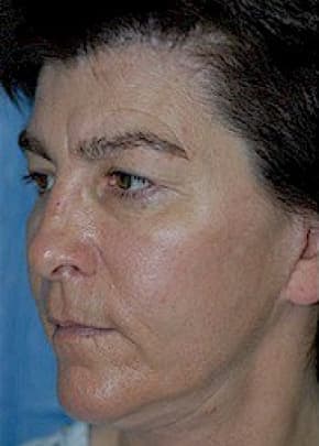 Cheeklift Threadlift Before & After Patient #1919