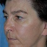 Cheeklift Threadlift Before & After Patient #2280