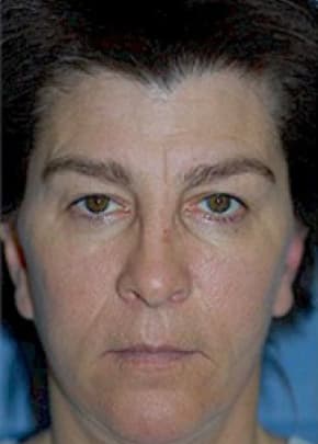 Cheeklift Threadlift Before & After Patient #1918