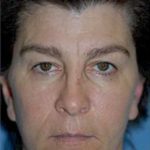 Cheeklift Threadlift Before & After Patient #2279