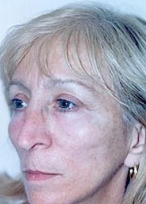 Cheeklift Threadlift Before & After Patient #1916