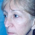 Cheeklift Threadlift Before & After Patient #1916