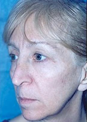 Cheeklift Threadlift Before & After Patient #2278
