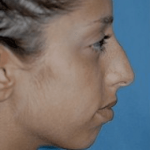 Chin and Cheek Implants Before & After Patient #1987