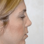 Chin and Cheek Implants Before & After Patient #1986