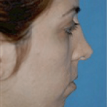 Chin and Cheek Implants Before & After Patient #1986