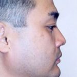 Chin and Cheek Implants Before & After Patient #1985