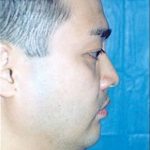 Chin and Cheek Implants Before & After Patient #1985