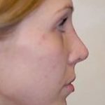 Chin and Cheek Implants Before & After Patient #1984