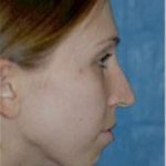 Chin and Cheek Implants Before & After Patient #1984