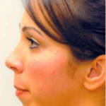 Chin and Cheek Implants Before & After Patient #1982