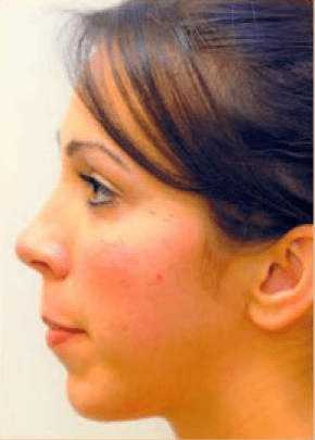 Chin and Cheek Implants Before & After Patient #1982