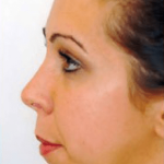 Chin and Cheek Implants Before & After Patient #1982
