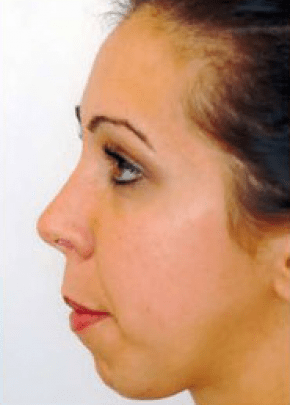 Chin and Cheek Implants Before & After Patient #1982